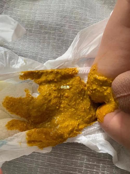 今天去医院儿科,顺便问了下医生,说这个大便金黄色,很正常,宝宝大便有