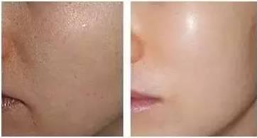 水光针会让你美得无可救药