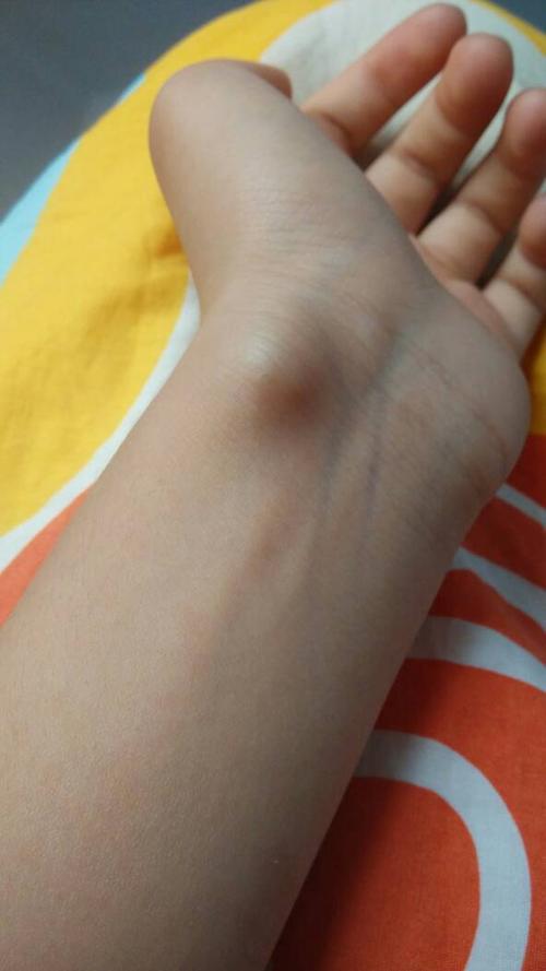 腱鞘囊肿.这个样有什么办法消除除了做手术!它已经长了半年了.