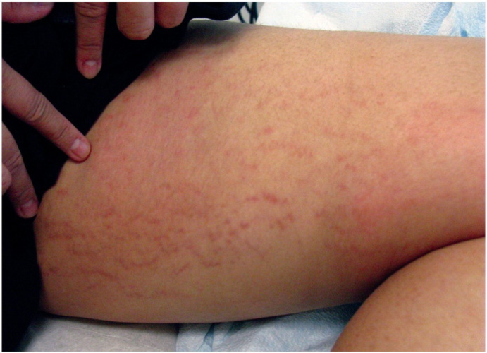 大腿上的膨胀纹,图片来源int j womens dermatolv
