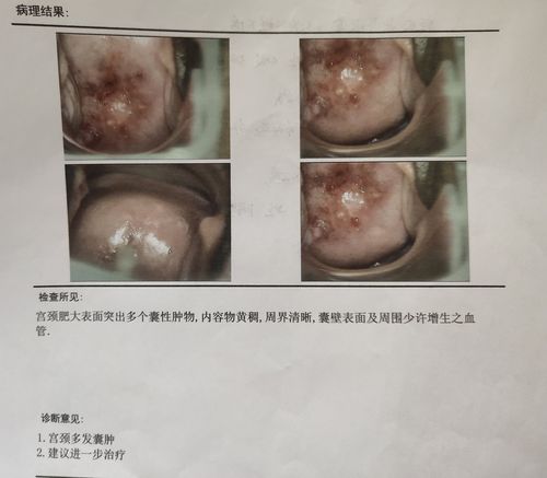 旋磁光治疗仪(可治疗宫颈糜烂,宫颈囊肿,息肉等)