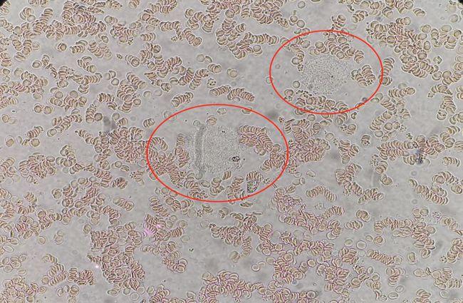 是谁在"捣乱"血小板计数?