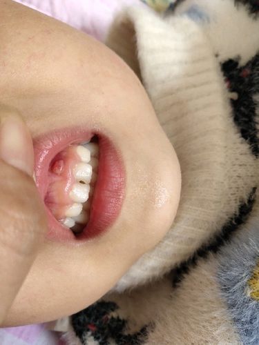 大儿子牙龈长了一个疙瘩怎么回事