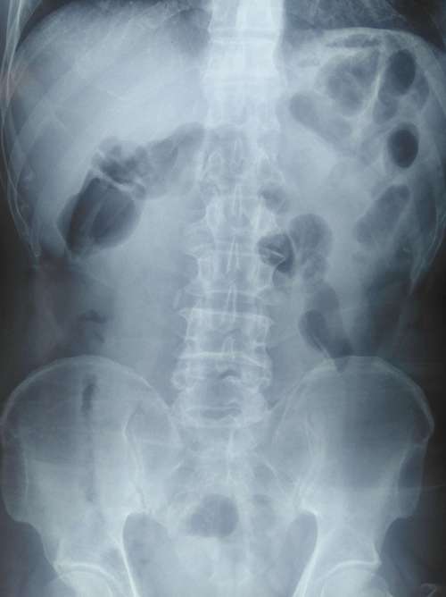 此次入院后腹部平片