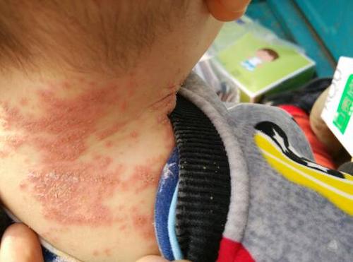 问:小孩有湿疹怎么快速治疗?