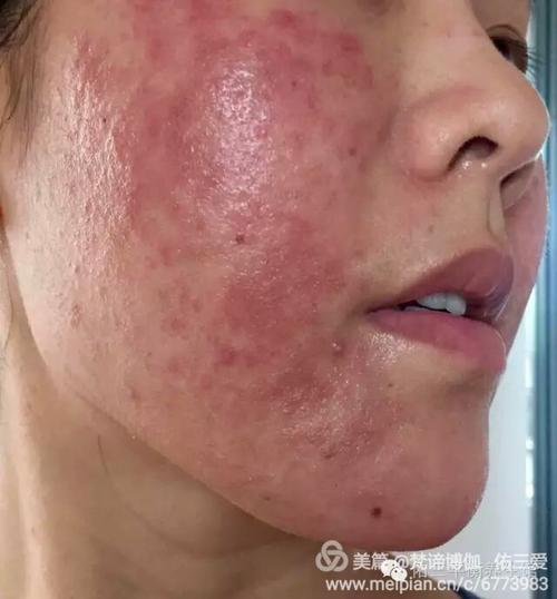 使用佑三软膏调理期间的排毒期(加重反应)