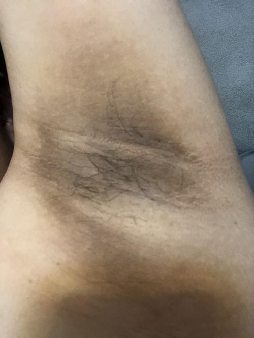 备孕期突然发现胳肢窝变黑了太吓人了
