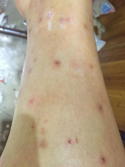 刚开始小腿上痒,抓破后伤口是圆孔状,去医院看过后说是皮肤过敏,用了
