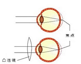 老花和远视有什么区别