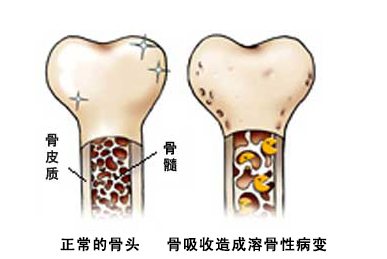 患骨癌能治好吗?医保广东药科大学肿瘤医院谈