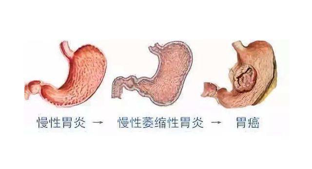 目前临床上关于肠上皮化生与胃癌的关系是怎样的
