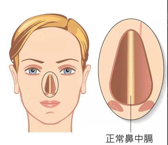 鼻中隔在哪里? 用什么来延长?