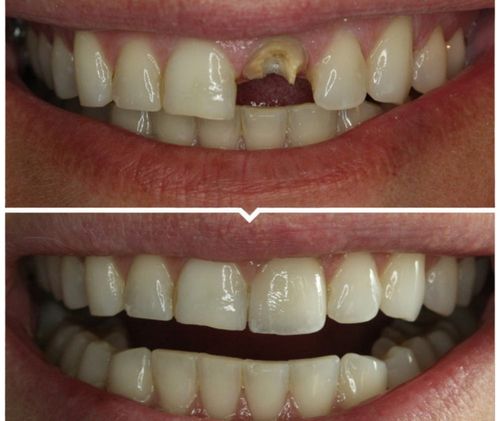 牙齿断了,是保留好?还是需要拔掉后重新镶牙