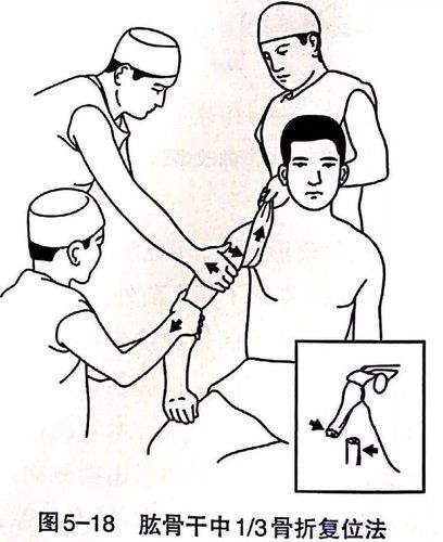 各部位骨折的完美复位手法,你值得拥有!|桡骨|关节