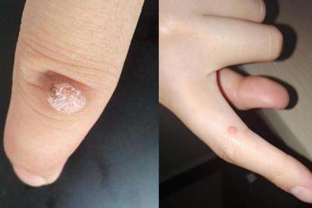 【图】怎么去除鱼鳞痣 教你一个简单安全的土方法