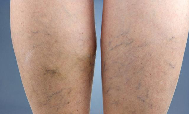 静脉曲张是久坐引起的?提醒:这2个习惯尽早改正,血管畅通无阻