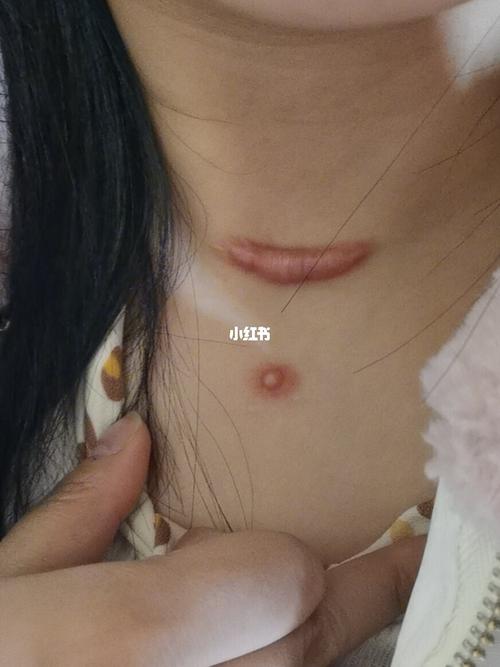 甲状腺手术疤痕增生_疤痕_甲状腺_手术疤_穿衣_医疗健康_医疗健康其他