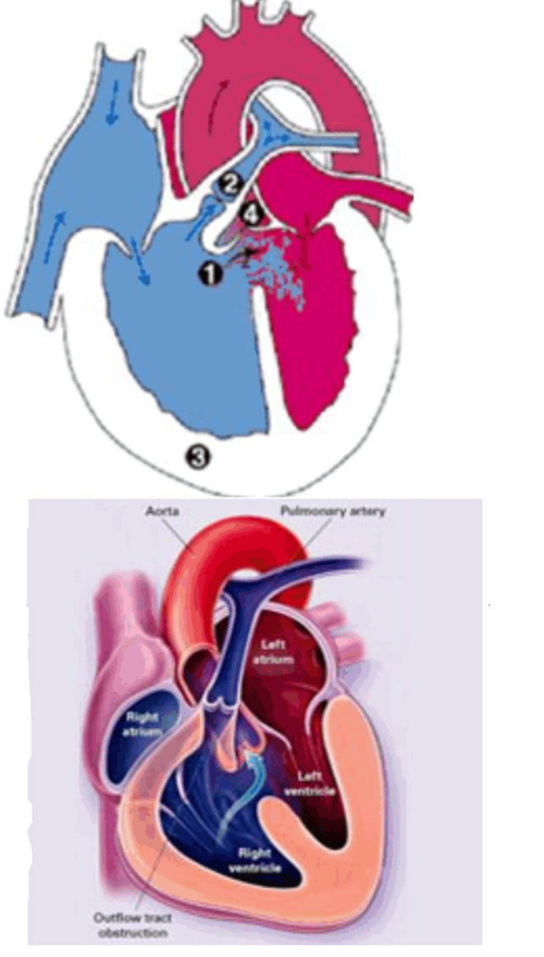 x线:右室肥厚表现,肺动脉段凹陷,形成木靴状