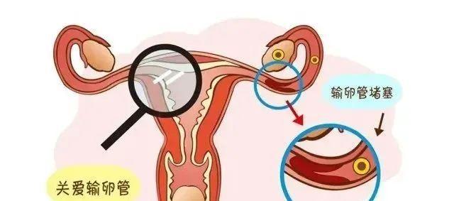 由于输卵管深藏体内,因此当其发生堵塞时,患者常无明显症状,多在因