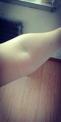 两个胳膊肘内侧长包疼痛