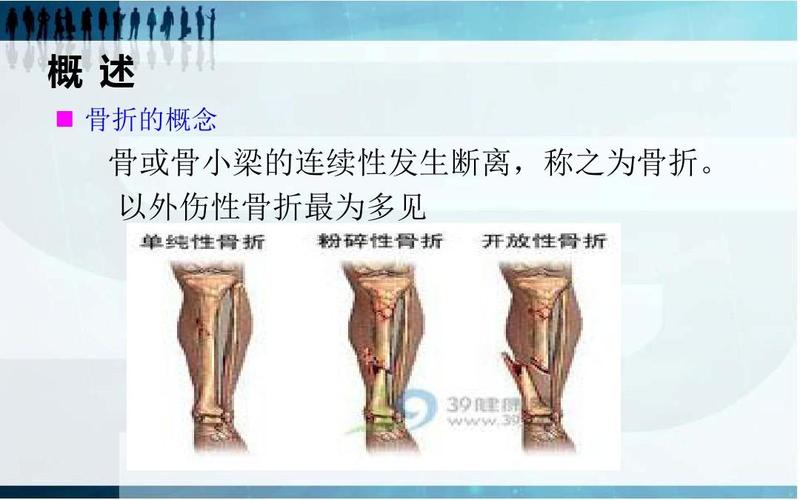 概 述   骨折的概念 骨或骨小梁的连续性发生断离,称之为骨折.