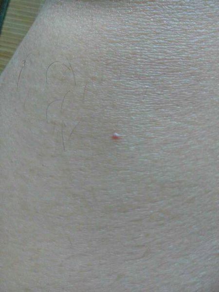 2014-06-05 刘英新 主治医师 肝病患者蜘蛛痣肝功正常后可消失吗 2014