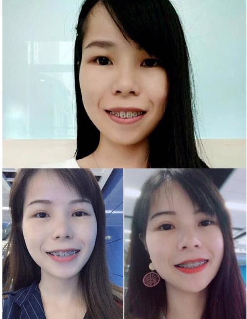 凸嘴牙齿紊乱,3年多终于摘下牙套,变化很大