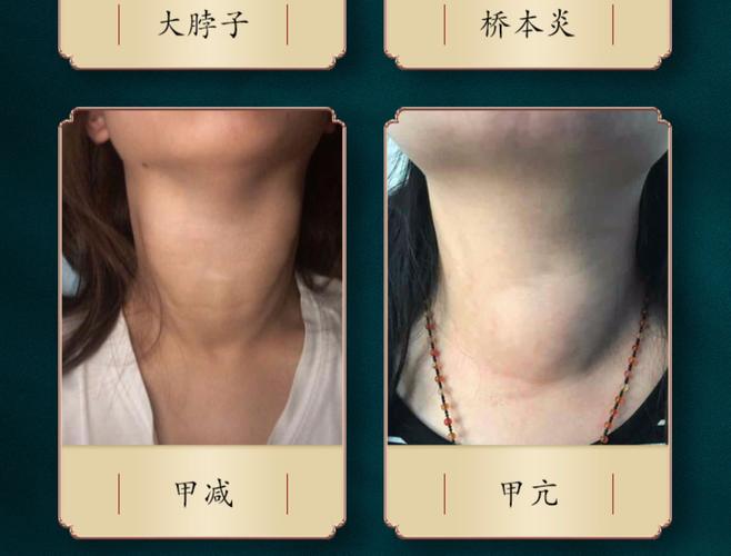 李时珍甲状腺贴甲状腺结节散结贴脖子肿大脖子痛粗