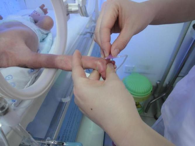 新生儿桡动脉穿刺技巧