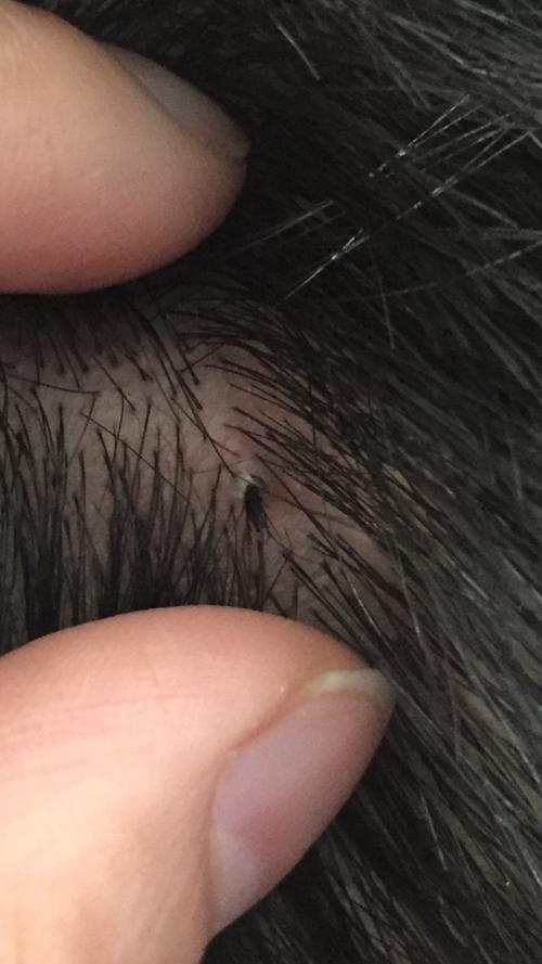 头发一个毛囊长几十根头发,有疼痛感,后来拔掉了,不知