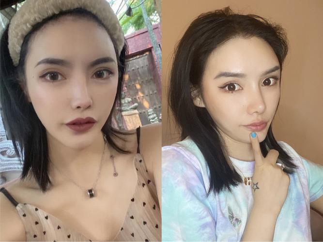 膨体眉弓做完有犄角,能不做就不做_整形_玻尿酸_异物感_消肿_混血