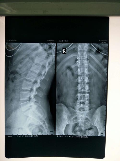 白山市中医院骨伤一疗区行腰椎间盘射频热凝消融术微创手术