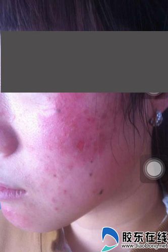 准新娘买茶树精油除痘脸颊被灼伤 几乎毁容(图)