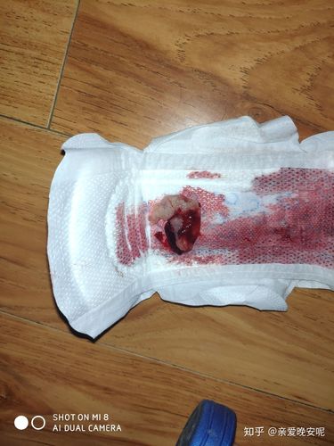 药流第二天 - 知乎