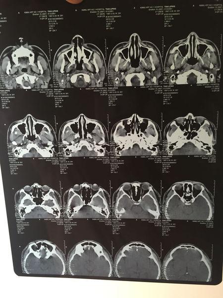 鼻子里面不能正常通气,以前以为是鼻窦炎结果不是,大家帮我看看这个ct
