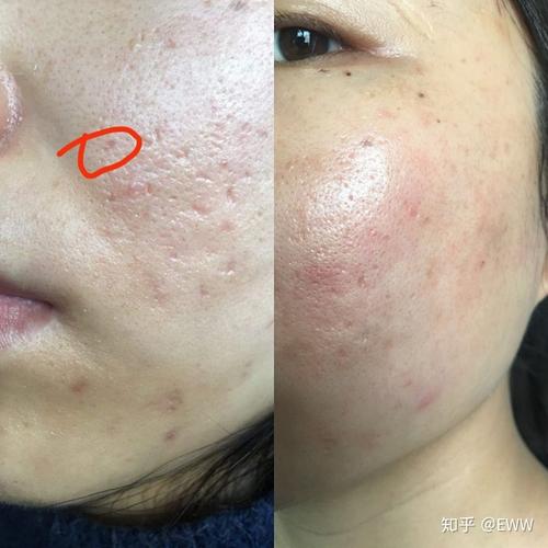 皮下分离 联合治疗痘坑 点阵激光 严后友