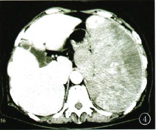 脾-副脾血管肉瘤的ct表现1例