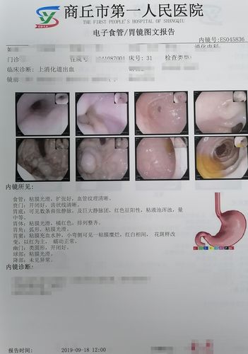 内镜下钛夹联合组织胶聚桂醇治疗胃底巨大静脉曲张1例