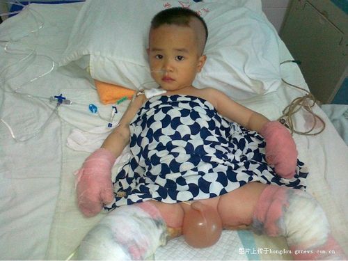 【转】两岁孩子掉石灰坑严重烧伤,希望好心人帮忙救助