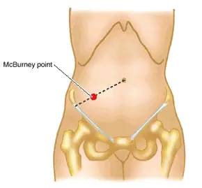 急性阑尾炎的7大体征 !