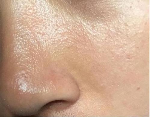 一个人湿气太重,脸上会有5个信号,请你快快祛湿!