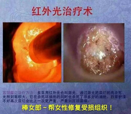 宫颈炎和宫颈糜烂是怎么回事