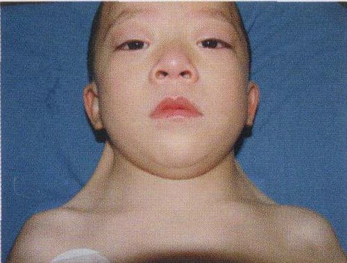 典型病例1:连续z成形术矫正先天性蹼颈畸形