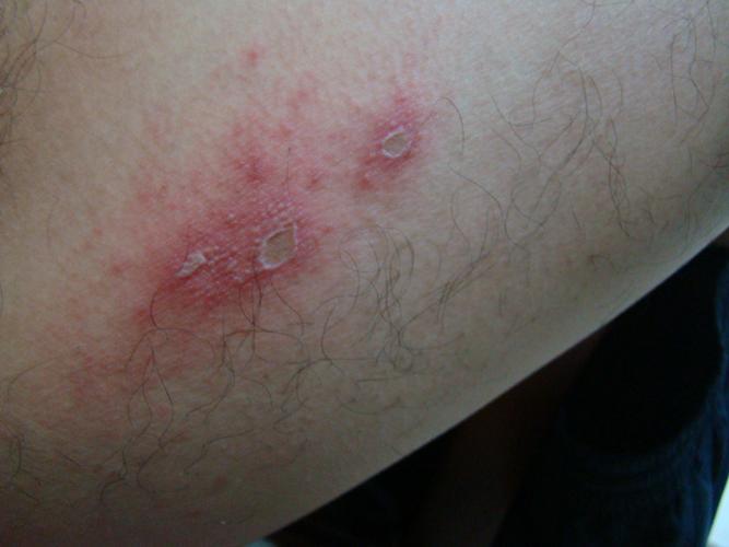 已经长了1周左右,在大腿内侧,因为早期看不到,以为只是毛囊炎,现在看