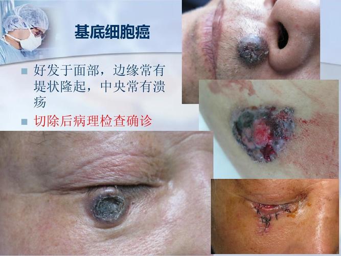 基底细胞癌   好发于面部,边缘常有 堤状隆起,中央常有溃 疡 切除后