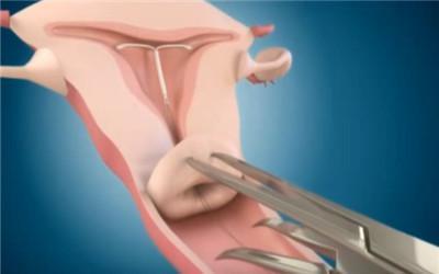 上环手术全过程(附图),上环后真是哭都没眼泪!