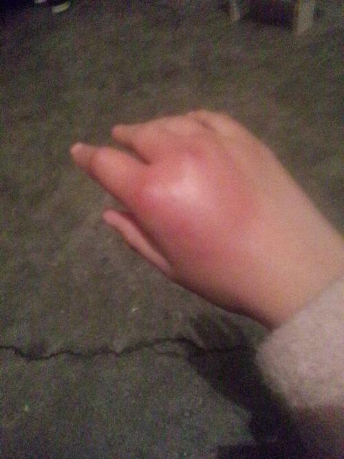手上因为前段时间被蜂子蛰了之后留下来难看