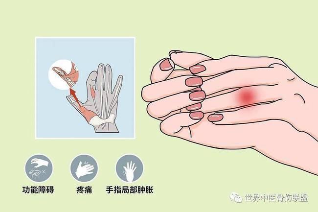 手指腱鞘炎治疗