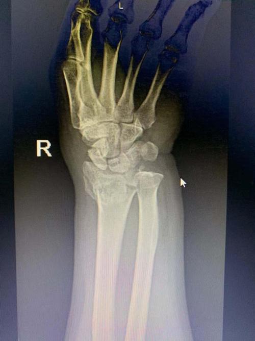 点,局部压痛明显,可触及骨擦音及骨右腕关节活动受限,右手各手指感