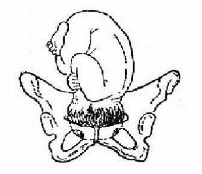 由于枕额径大于骨盆入口前后径,胎头矢状缝坐落在骨盆入口右斜径上,胎